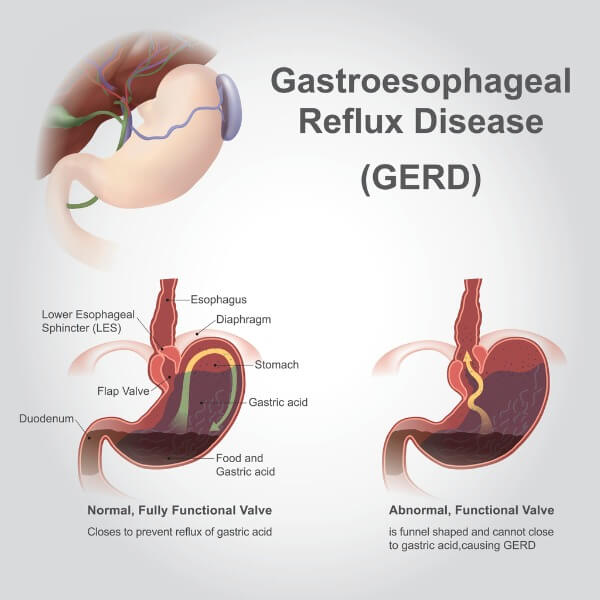 gastroesophageal reflux medication