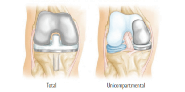 Diagram of total & partial knee replacement 